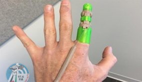 استخدام تقنيات الطباعة المجسمة لصناعة أصبع آلي مرن