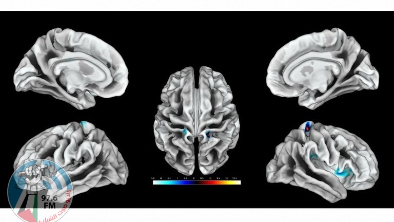 دراسة أمريكية تكشف عن مرحلة دماغية غريبة تسبق الوفاة