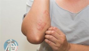 أكثر العلامات الجلدية انتشاراً عند الإصابة بـ “أوميكرون”
