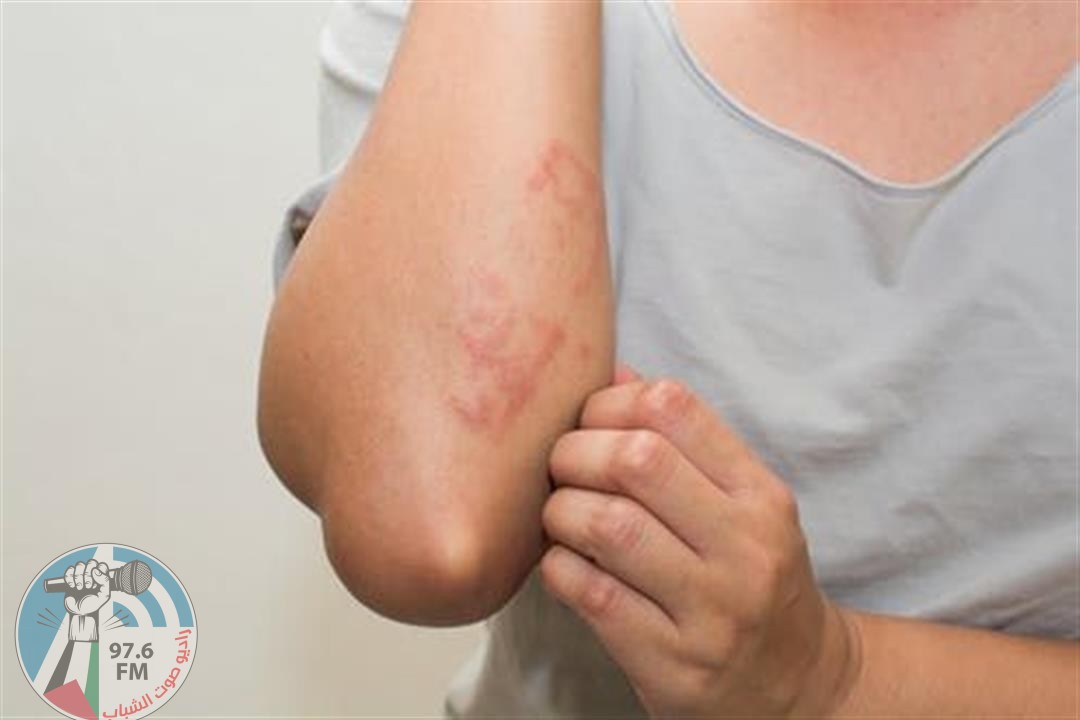 أكثر العلامات الجلدية انتشاراً عند الإصابة بـ “أوميكرون”