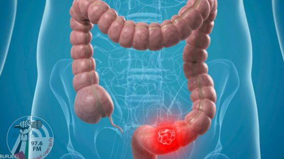 عنصران في نظامنا الغذائي وراء الإصابة بسرطان القولون