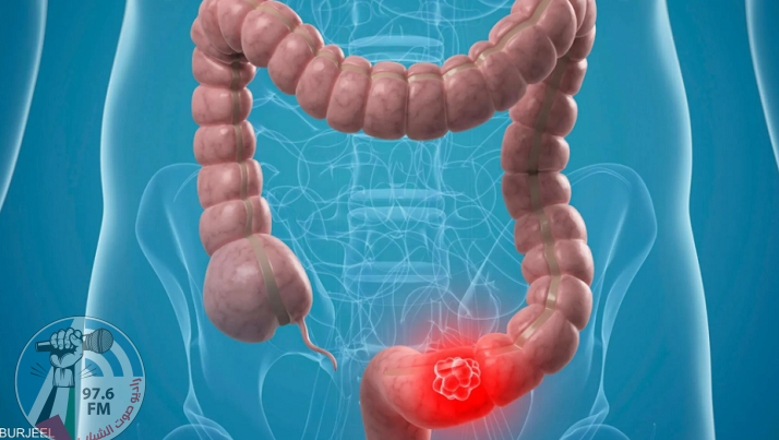عنصران في نظامنا الغذائي وراء الإصابة بسرطان القولون