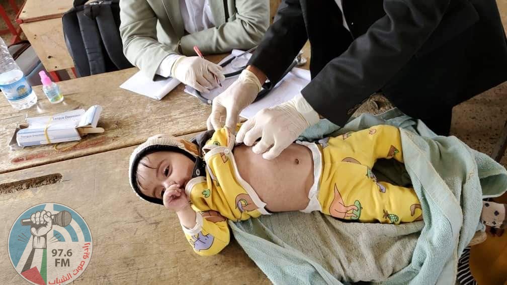أطفال مصابين بالحصبه في اليمن