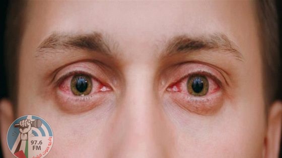 وباء العين الوردية