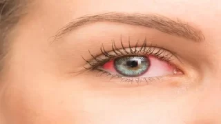 متلازمة العين الجافة.. لماذا تدمع العيون في فصل الشتاء؟