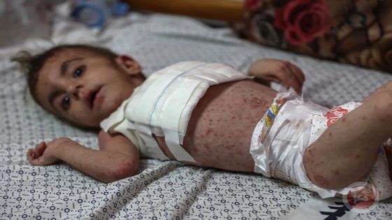 انتشار واسع للأمراض الجلدية في صفوف النازحين بقطاع غزة