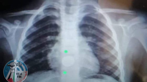 سحب بطارية من مريء طفل عمره 5 سنوات بعد 6 أيام من ابتلاعها