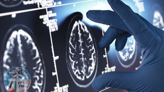 أوروبا توافق على أول دواء يستهدف السبب الجذري لمرض ألزهايمر