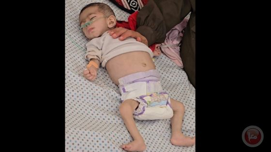 استشهاد طفلة في غزة بسبب المجاعة ما يرفع الحصيلة إلى 54