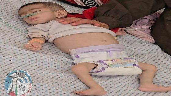 بسبب المجاعة: وفاة طفلة في مدينة غزة