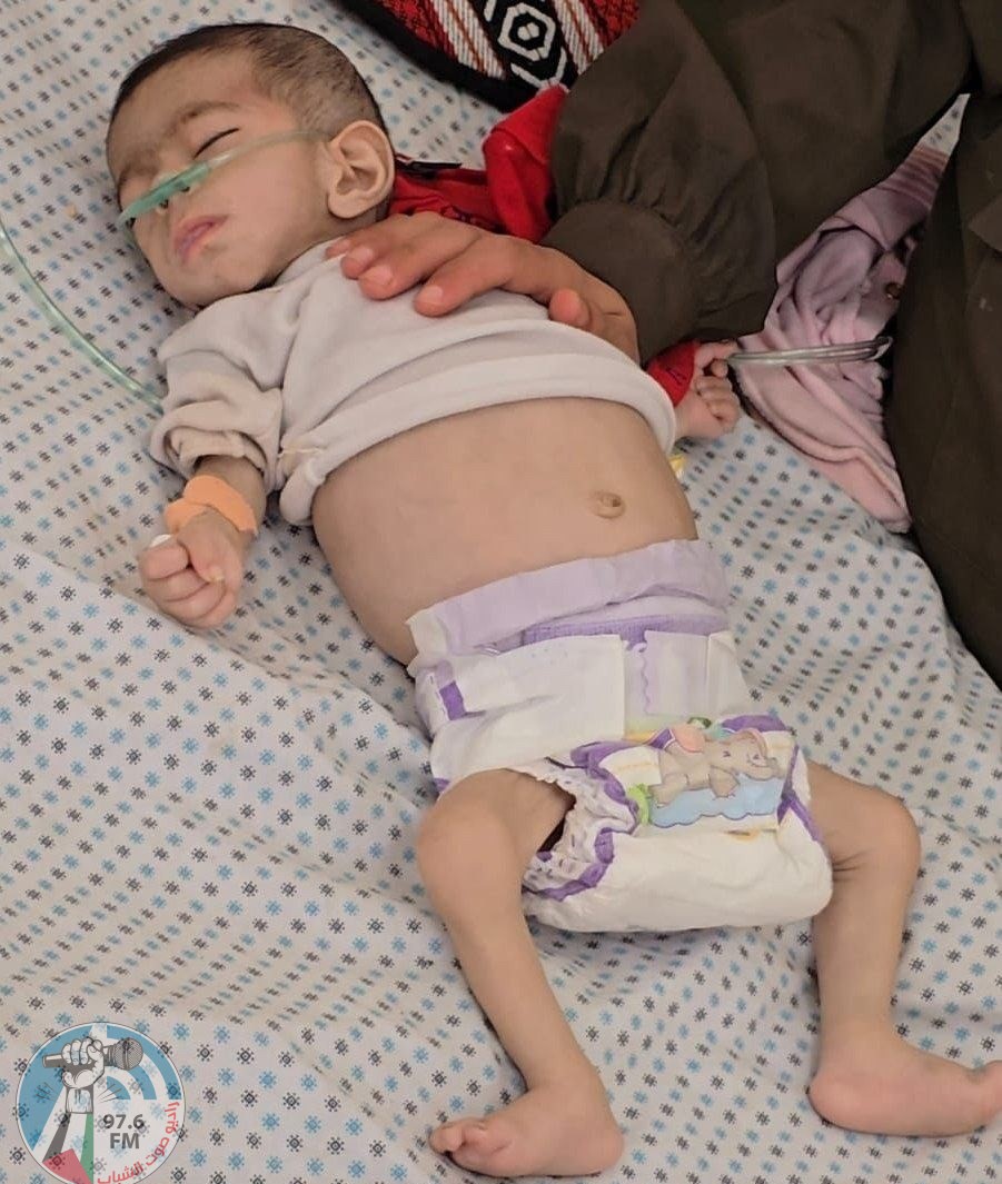 بسبب المجاعة: وفاة طفلة في مدينة غزة