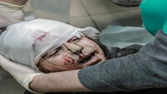 1500 مواطنا بغزة فقدوا البصر بسبب الحرب