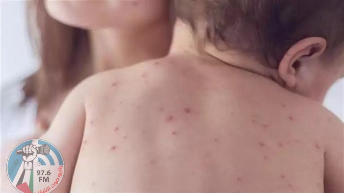 الحصبة تعود بقوة إلى الولايات المتحدة: أكثر من ألف إصابة مؤكدة و3 وفيات