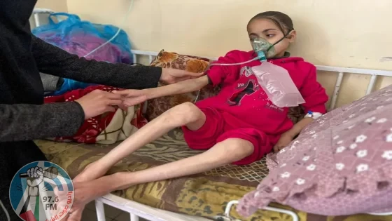 “الصحة العالمية”: 112 طفلا يدخلون مستشفيات غزة يوميا بسبب سوء التغذية