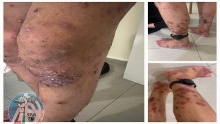 شؤون الأسرى: إهمال طبي متعمد للأسرى المصابين بـ “سكايبوس” في سجن مجدو