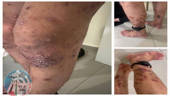 شؤون الأسرى: إهمال طبي متعمد للأسرى المصابين بـ “سكايبوس” في سجن مجدو