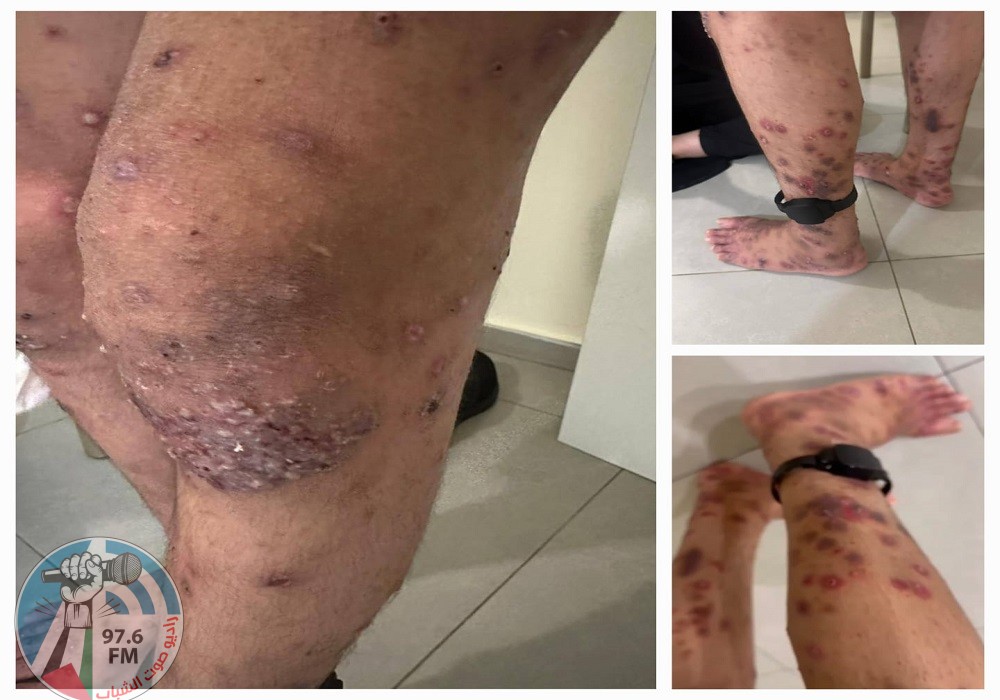 شؤون الأسرى: إهمال طبي متعمد للأسرى المصابين بـ “سكايبوس” في سجن مجدو