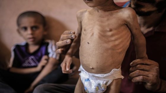 الأمم المتحدة: أكثر من مليون طفل يعانون من الجوع بغزة
