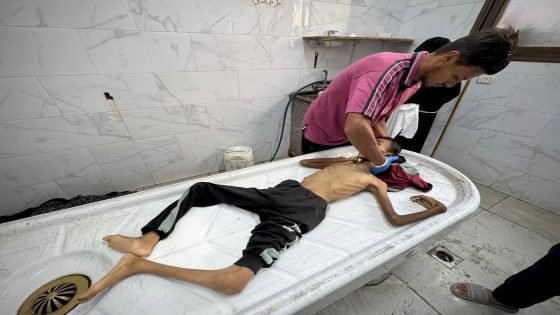 122 شهيدا بسبب المجاعة في قطاع غزة بينهم 83 طفلا
