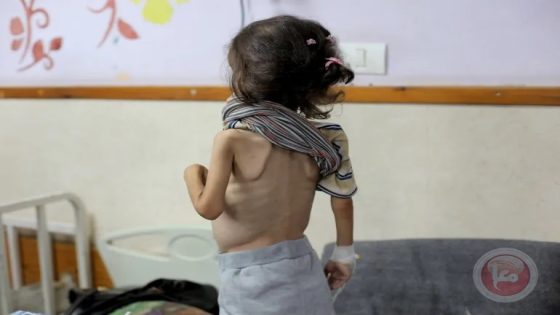 استشهاد طفلة جديدة بسبب الجوع في غزة