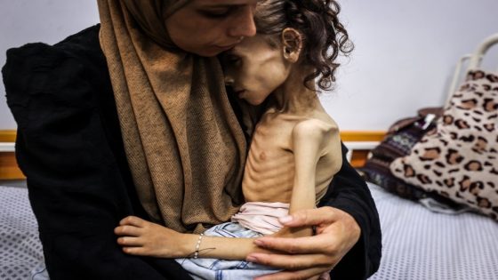 الصحة العالمية: شخصنا نحو 12 ألف طفل دون سن الخامسة يعانون من سوء التغذية