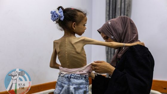 5 وفيات بينهم طفلان نتيجة المجاعة وسوء التغذية في قطاع غزة