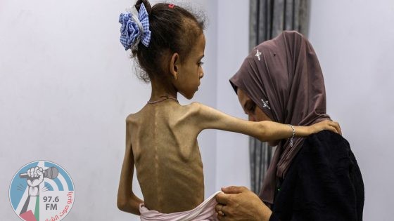 6 وفيات نتيجة المجاعة وسوء التغذية خلال الساعات الـ24 الماضية