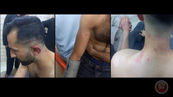 3 إصابات جراء اعتداء قوات الاحتلال غرب سلفيت