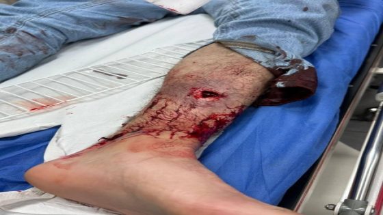 إصابتان بالرصاص الحي إحداها حرجة في الدهيشة جنوب بيت لحم