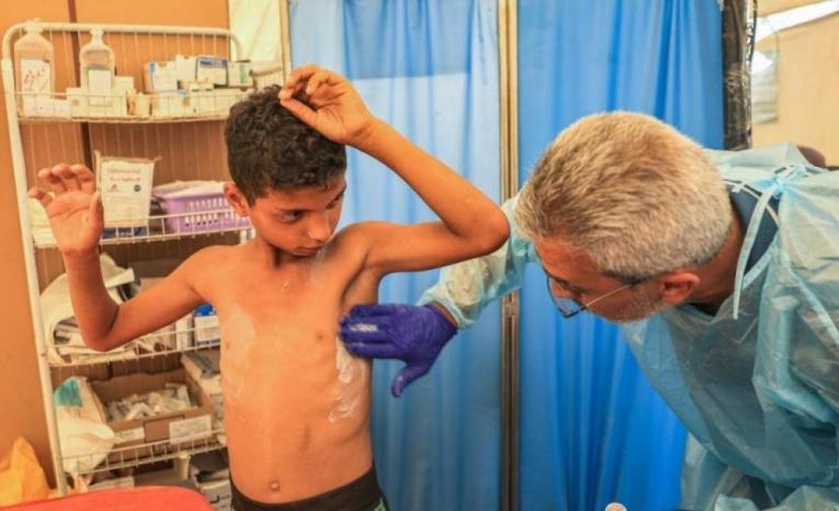 الأمم المتحدة تُحذر من تفشٍ واسع لـ "جدري الماء" يُهدد النازحين في قطاع غزة